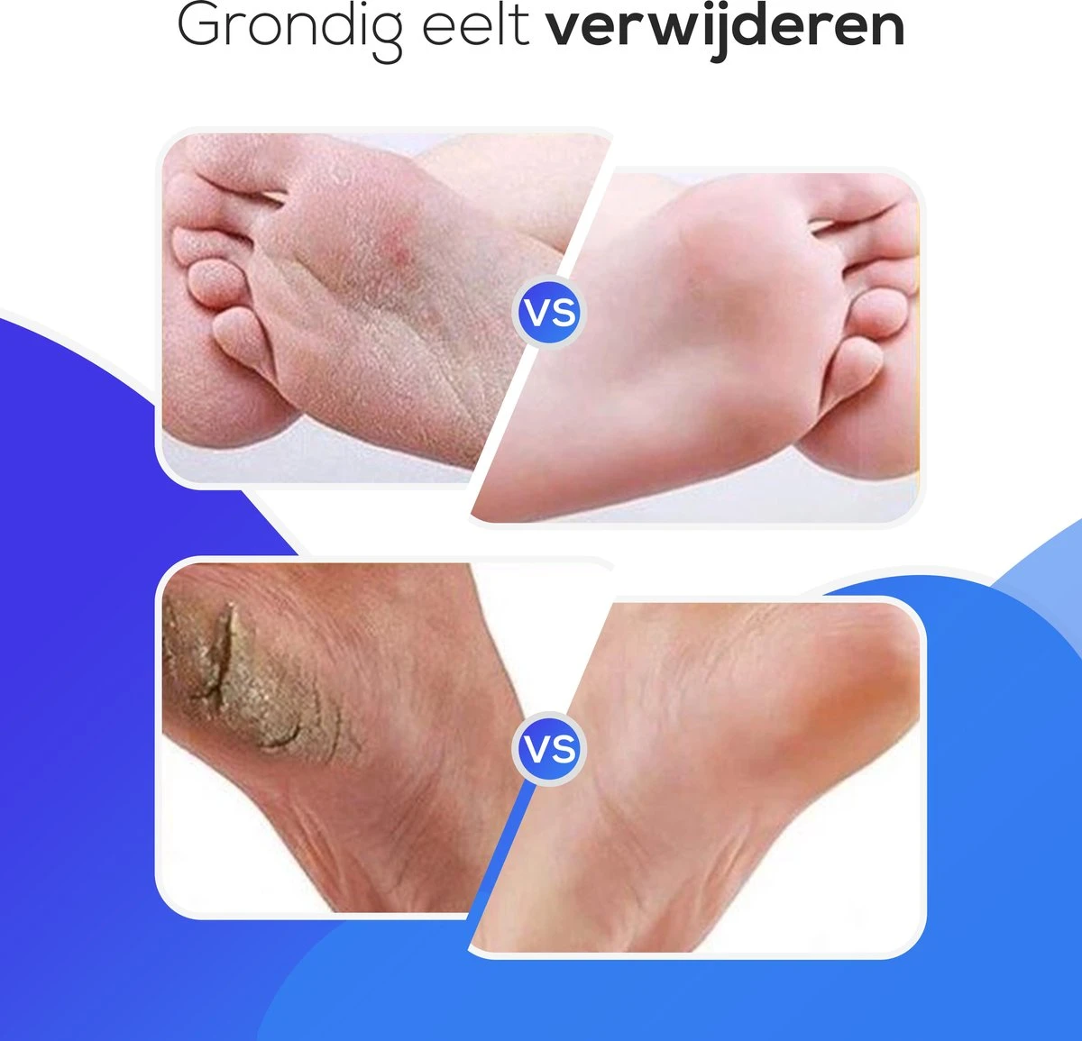 LifeWise Elektrische Eelt Verwijderaar - Voetvijl - 60 Vervangbare Schuurpads - Netstroom Adapter - Image 9