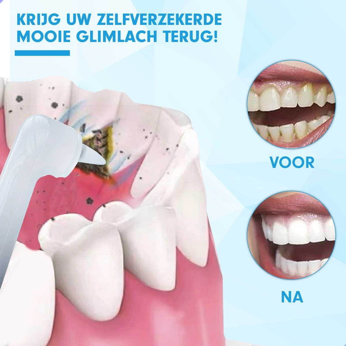 DEN-T® PRO P350 Elektrische Tandenpolijster - Wit - 5 Standen - 5 Opzetstukken - Polijstmachine - Polijstset - Tanden Polijsten - - Image 5