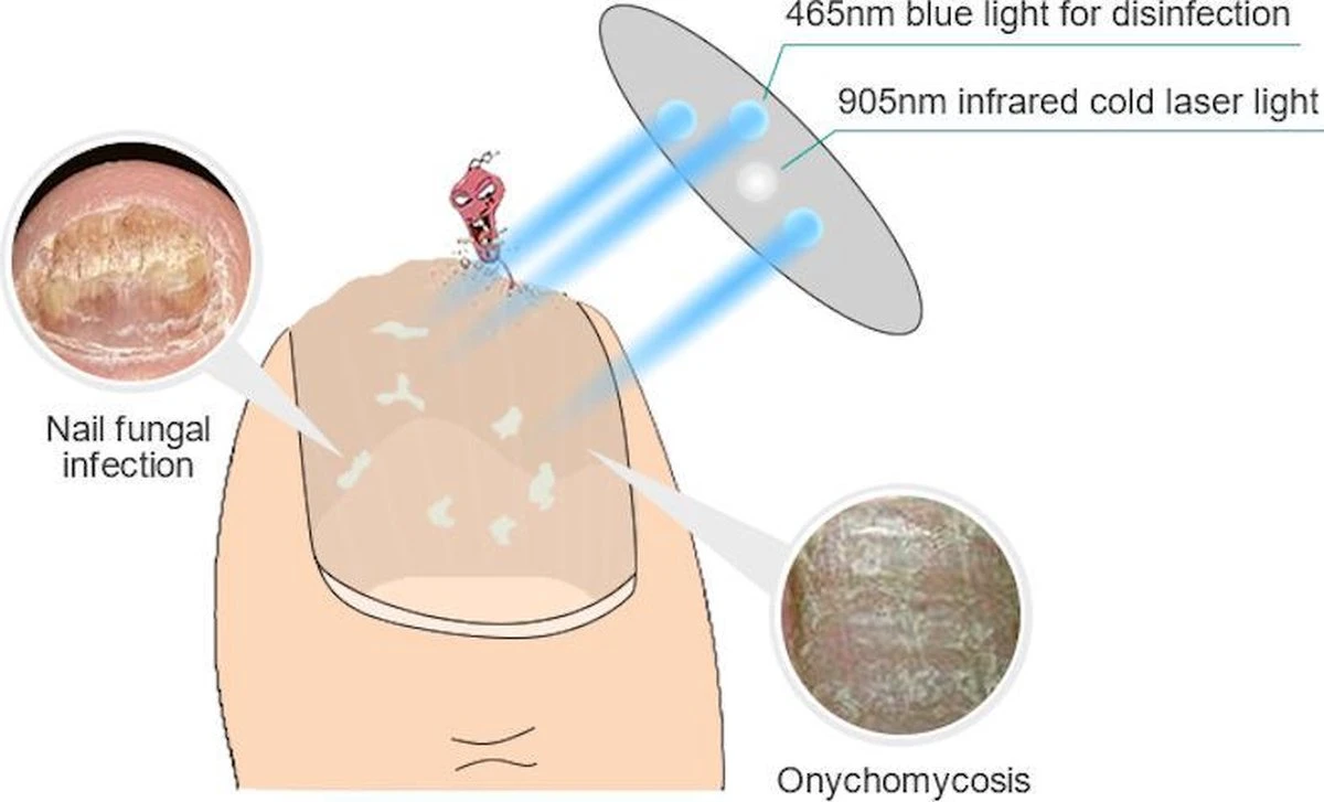 Anti Schimmelnagel Kalknagel Laserapparaat Om Zelf Te Behandelen, Veilig, Effectief, Snel En Pijnloos, Koude Laser Behandeling Voor Thuisgebruik, Voor Tenen En Vingers. Oplaadbaar. - Image 2