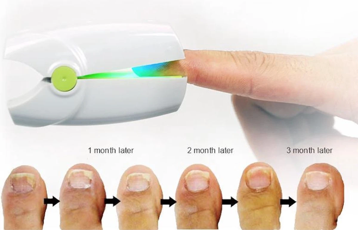 Anti Schimmelnagel Kalknagel Laserapparaat Om Zelf Te Behandelen, Veilig, Effectief, Snel En Pijnloos, Koude Laser Behandeling Voor Thuisgebruik, Voor Tenen En Vingers. Oplaadbaar. - Image 3